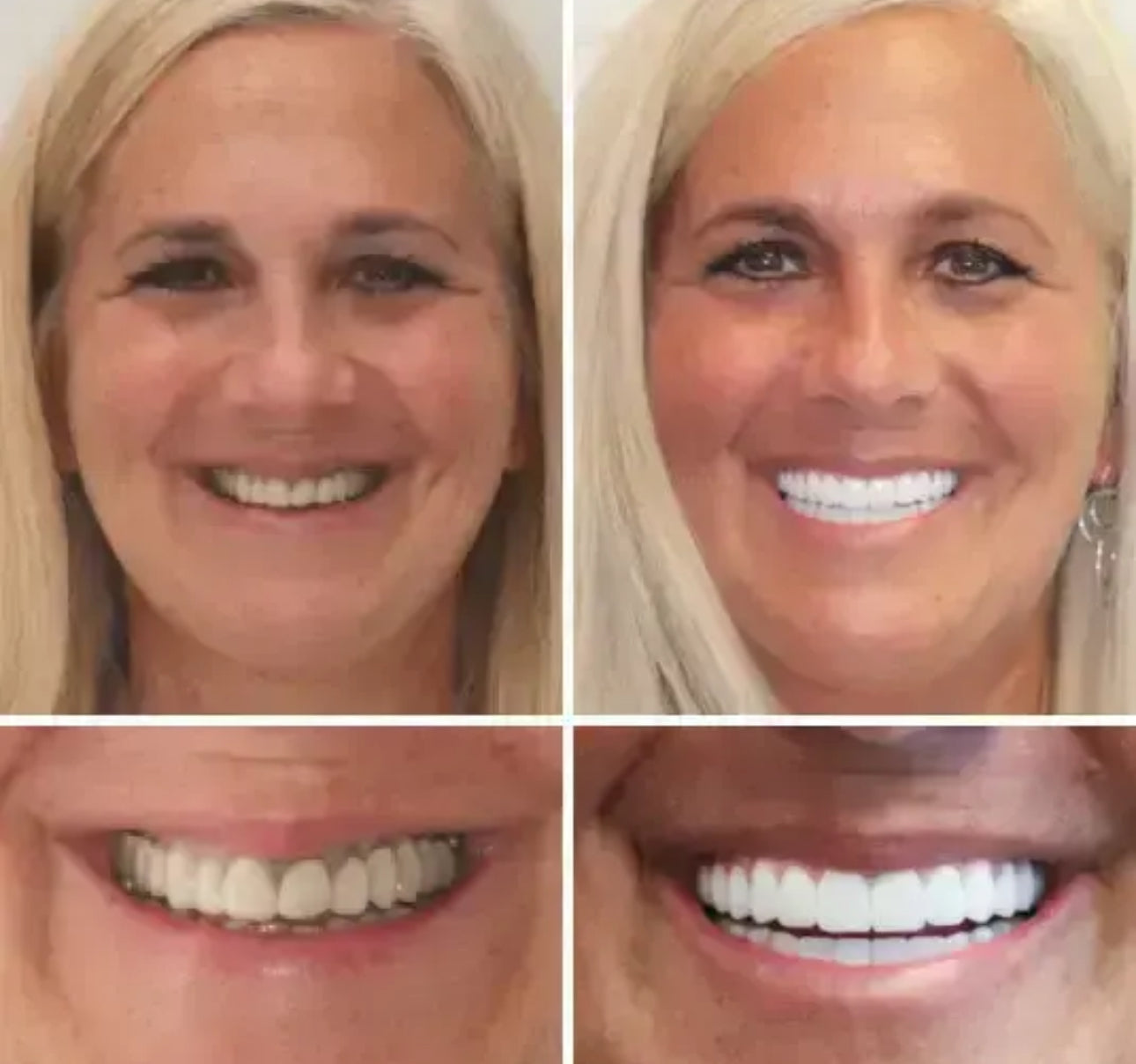 Premium Zahnprothese – Verblendung Natürliches Lächeln & perfekter Sitz