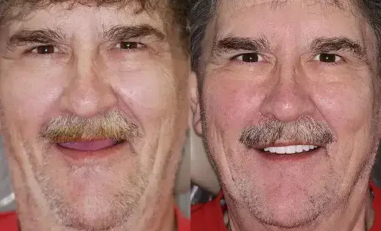 Premium Zahnprothese – Verblendung Natürliches Lächeln & perfekter Sitz