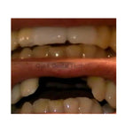 Quick Dental Tooth ™️ Provisorischer Zahnersatz